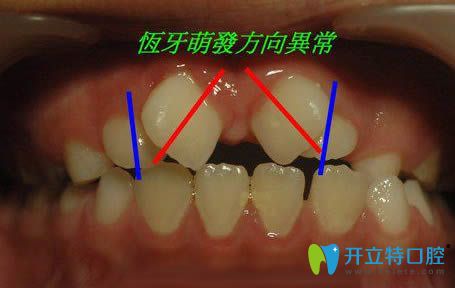 恒牙长歪会自动调整吗，恒牙长出来是歪的怎么办