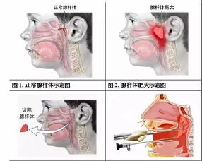 腺样体图片，腺样体图片面容