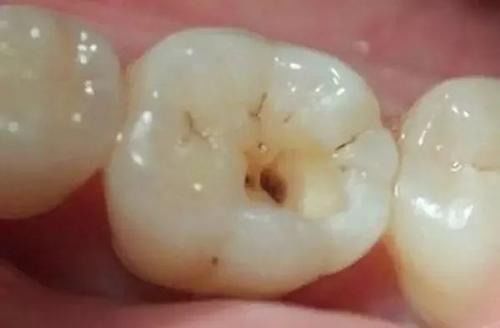 梦见牙齿碎了并吐出来，梦见牙齿碎了并吐出来还有血