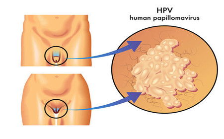 男人感染hpv是什么症状，男人感染hpv是什么症状图片