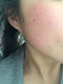 脸部发红发热，脸部发红发热怎么解决