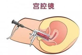宫腔镜清宫怎么做