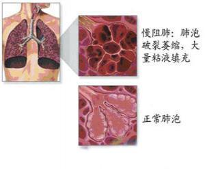 慢阻肺的症状，慢阻肺的症状及治疗方法