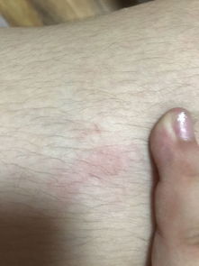 狗狗爪子划破轻微破皮，打过针的狗爪子划破轻微破皮