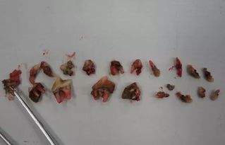 烂牙根长期不拔会怎样，残留的牙根长时间不拔会怎么样