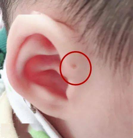 周易算命 耳朵后面有小眼好吗?