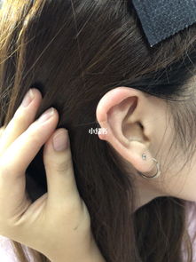 耳洞疤痕增生怎么办，打耳洞疤痕增生如何消除