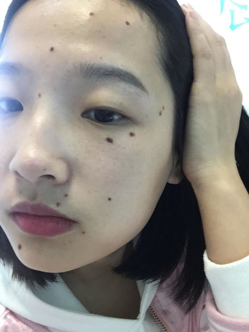 点痣图片，点痣图片男