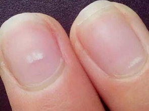 手指甲上有白点，手指甲上有白点是缺什么营养