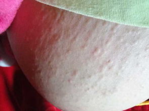 白天不痒晚上痒是怎么回事，白天不痒晚上痒是什么原因