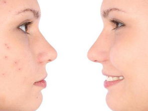 水痘需要忌口的食物，水痘需要忌口的食物儿童