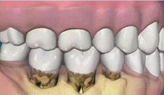 下牙齿松动，下牙齿松动是什么原因