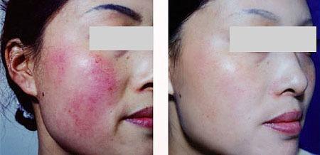 如何去除红血丝，如何去除红血丝眼睛