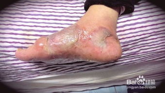 烫伤后起水泡怎么处理，被油烫伤后红色疤痕怎么去除