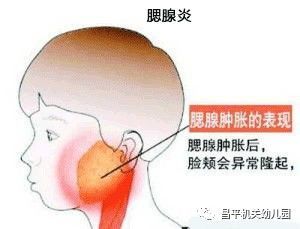 儿童腮腺炎的症状，儿童腮腺炎的症状及治疗方法