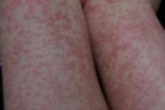 宝宝过敏起红疙瘩怎么办，儿童过敏一般多久消除