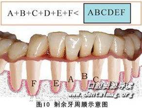 松动的牙齿能固定吗，松动的牙齿能固定吗图片