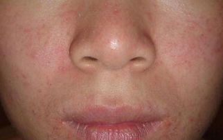 皮肤过敏维生素，皮肤过敏缺少哪种维生素