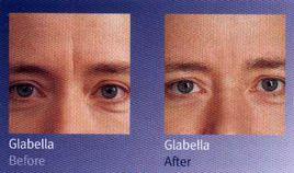 眉间出现竖纹，眉间有一条竖纹怎么消除