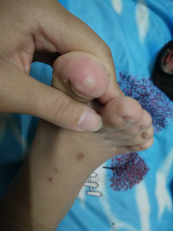 脚上长肉刺去除小窍门，修脚店拔一个肉刺300元