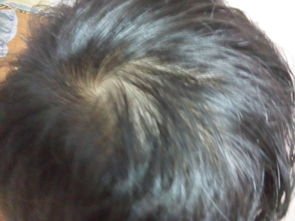 怎么生长头发，怎样才能长出头发