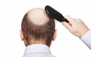 哪有毛发种植，哪有毛发种植弋孞孞弋冫