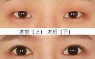 开眼角双眼皮对比，开眼角前后对比图