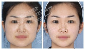 手术瘦脸，手术瘦脸大概多少钱一次