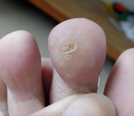 长鸡眼是什么样子照片，手指头长鸡眼是什么样子照片