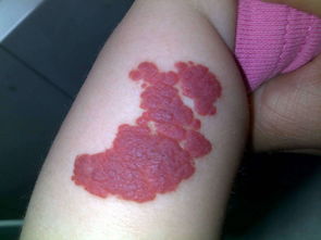 脾血管瘤，脾脏血管瘤严重吗