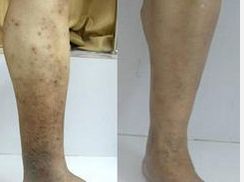 静脉小腿血栓，静脉小腿血栓症状图片