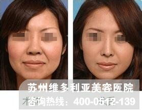 鼻翼缩小方法，鼻翼缩小的方法有几种