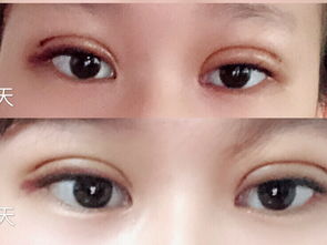 双眼皮吸脂
