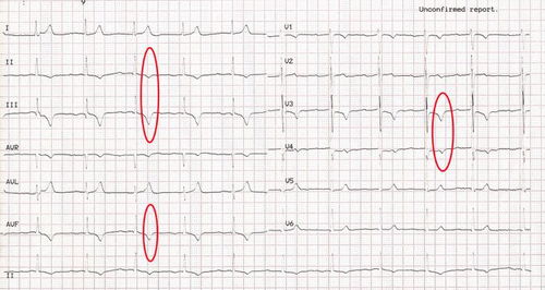 心电图t波改变是什么意思