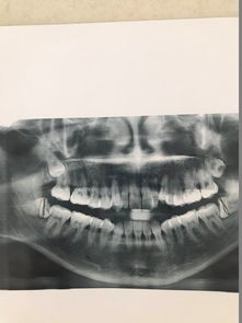 没长出来的智齿能拔吗，拔智齿后那个洞臭到恶心