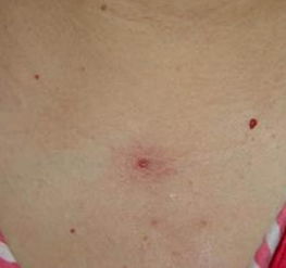 什么叫血管痣?有何危害?怎样医治?