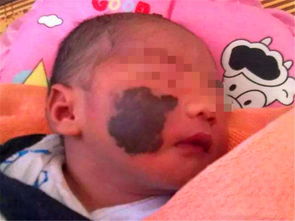 胎记怎么引起的，胎记是什么样子的