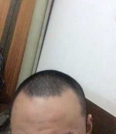 头的两边没头发怎么办，头的两边没头发怎么办图片