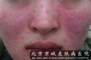 脸上皮炎，脸上皮炎怎么治