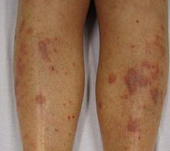 扁平苔藓图片，扁平苔藓图片欣赏