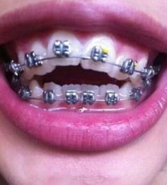 牙齿矫正年龄限制吗，矫正牙齿有限制年龄吗