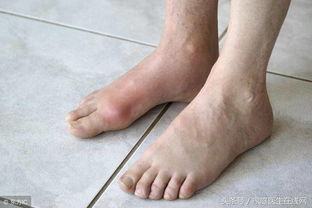 大脚趾，大脚趾头麻木怎么回事