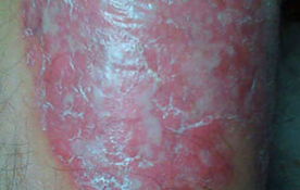 皮肤皮屑，皮肤皮屑多怎么回事