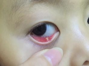 眼睛长针眼图片，眼睛长针眼怎么治疗