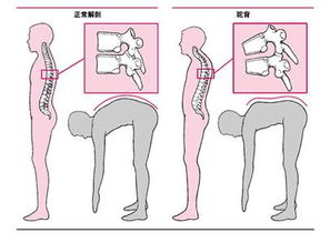 驼背有什么害处 如何改正?