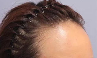 怎样才能让发际线变低