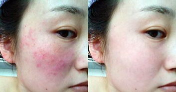 什么是激素皮肤