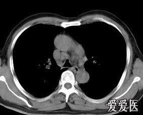 肺内见结节样钙化是什么意思