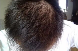 脸部毛囊堵塞该怎么办?