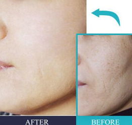 水光针费用多少